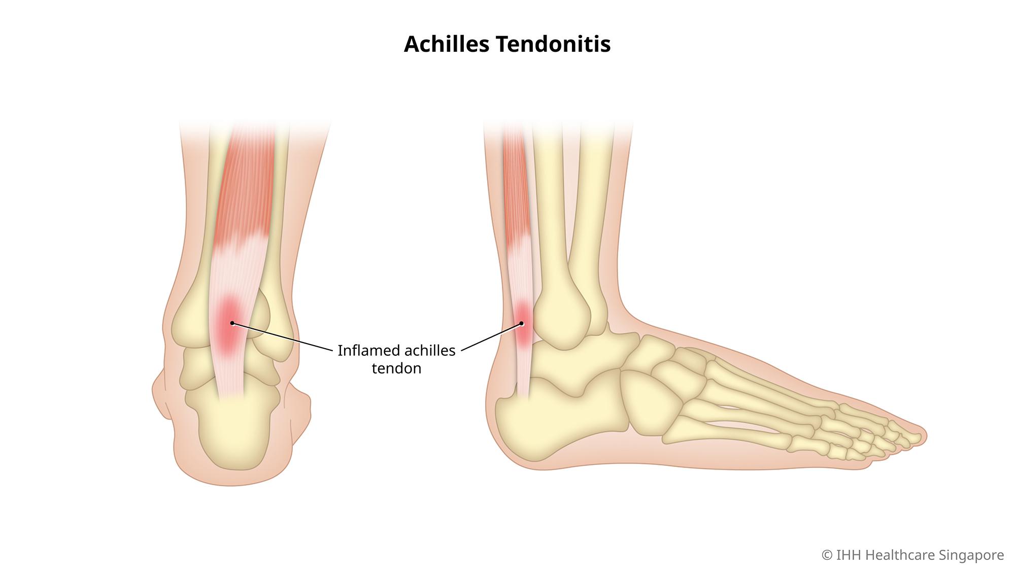 Is Your Achilles Talking Back? Here’s What You Need to Know